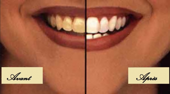 Blanchiment Dentaire en cosmétologie