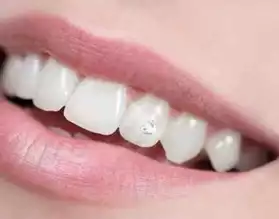 Strass dentaire reutilisable ss perçage